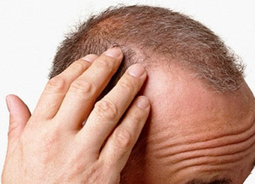alopecia stress
