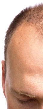 cure e rimedi per alopecia seborroica e caduta capelli causata da seborrea