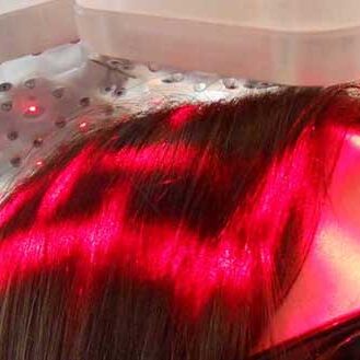 Il laser per capelli aiuta a favorire la ricrescita dei capelli: uno studio clinico lo dimostra
