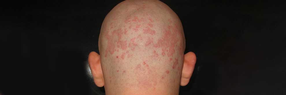 Dermatite seborroica del cuoio capelluto e croste in testa