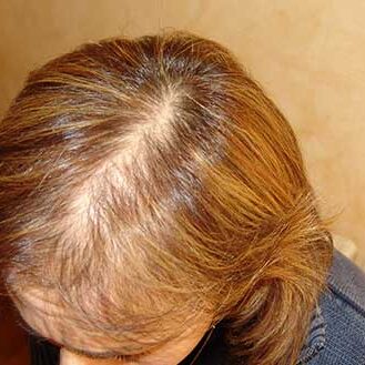 Perdita capelli – Defluvio Telogen